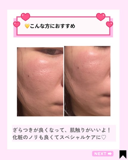 トラブルパッチマスク/EIOM/その他スキンケアを使ったクチコミ(7枚目)