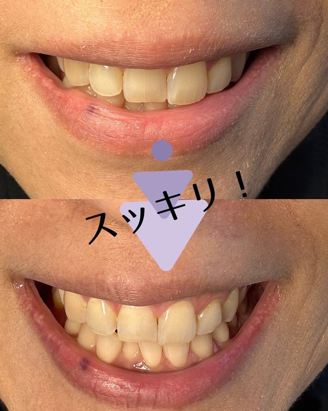 アパデント トータルケア/アパデント/歯磨き粉を使ったクチコミ(8枚目)