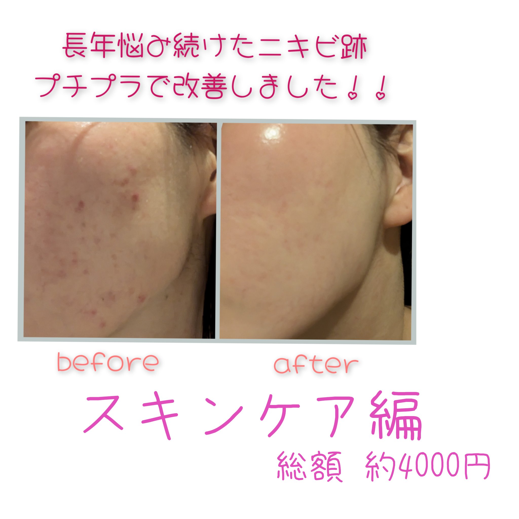 コールドクリーム/ウテナモイスチャー/クレンジングクリームを使ったクチコミ（1枚目）