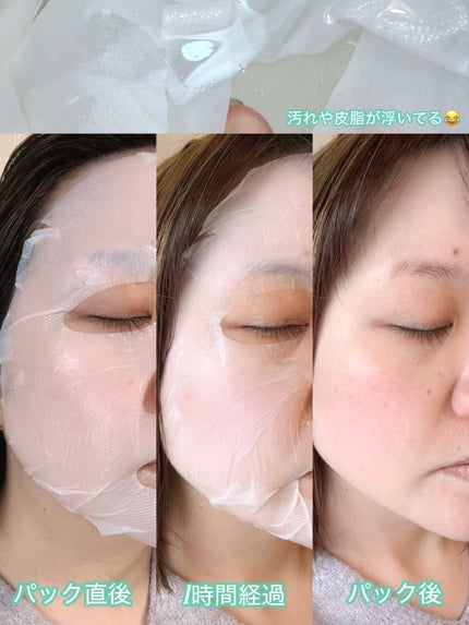 トラブルパッチマスク/EIOM/その他スキンケアを使ったクチコミ(5枚目)