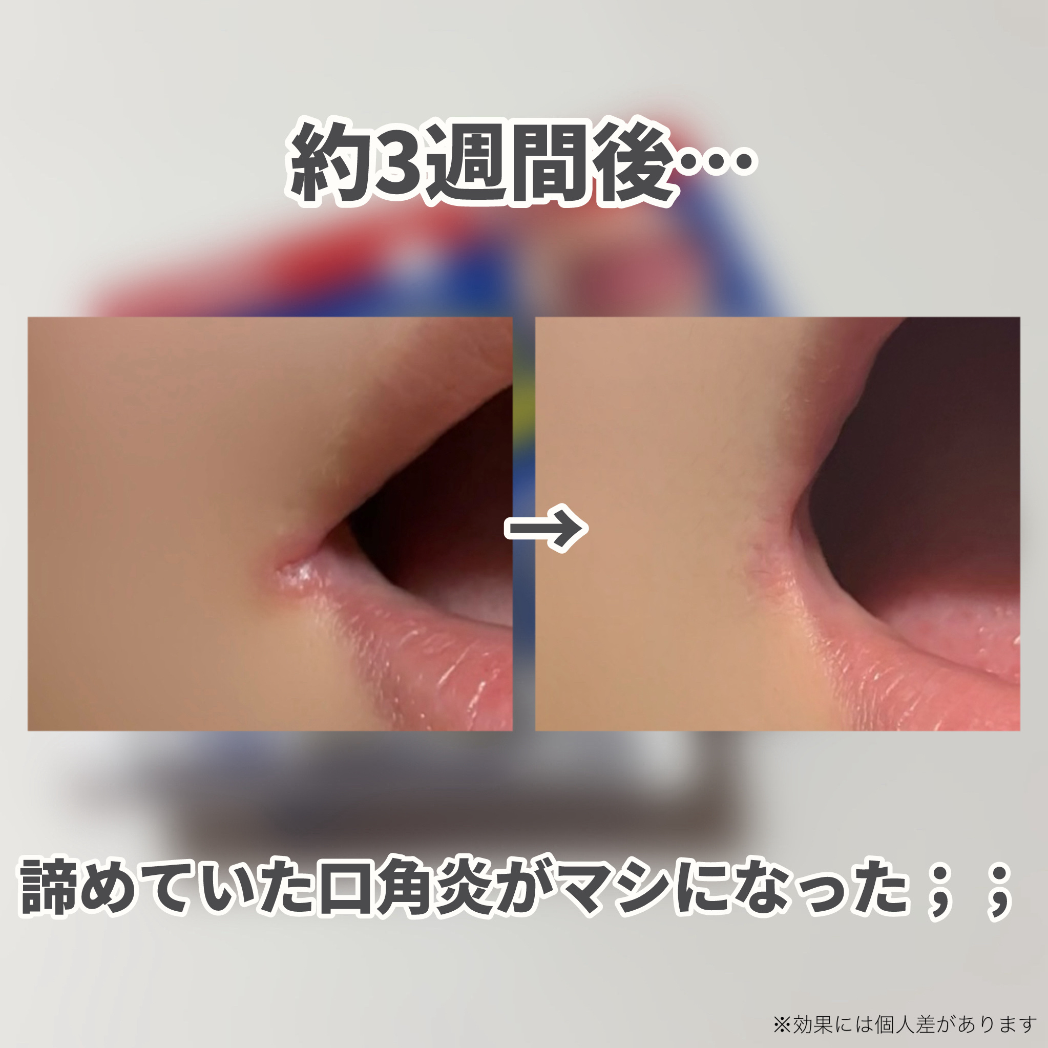 ヒビプロLP(医薬品)/メンソレータム/その他を使ったクチコミ（3枚目）