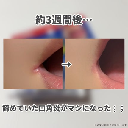 ヒビプロLP(医薬品)/メンソレータム/その他を使ったクチコミ(3枚目)