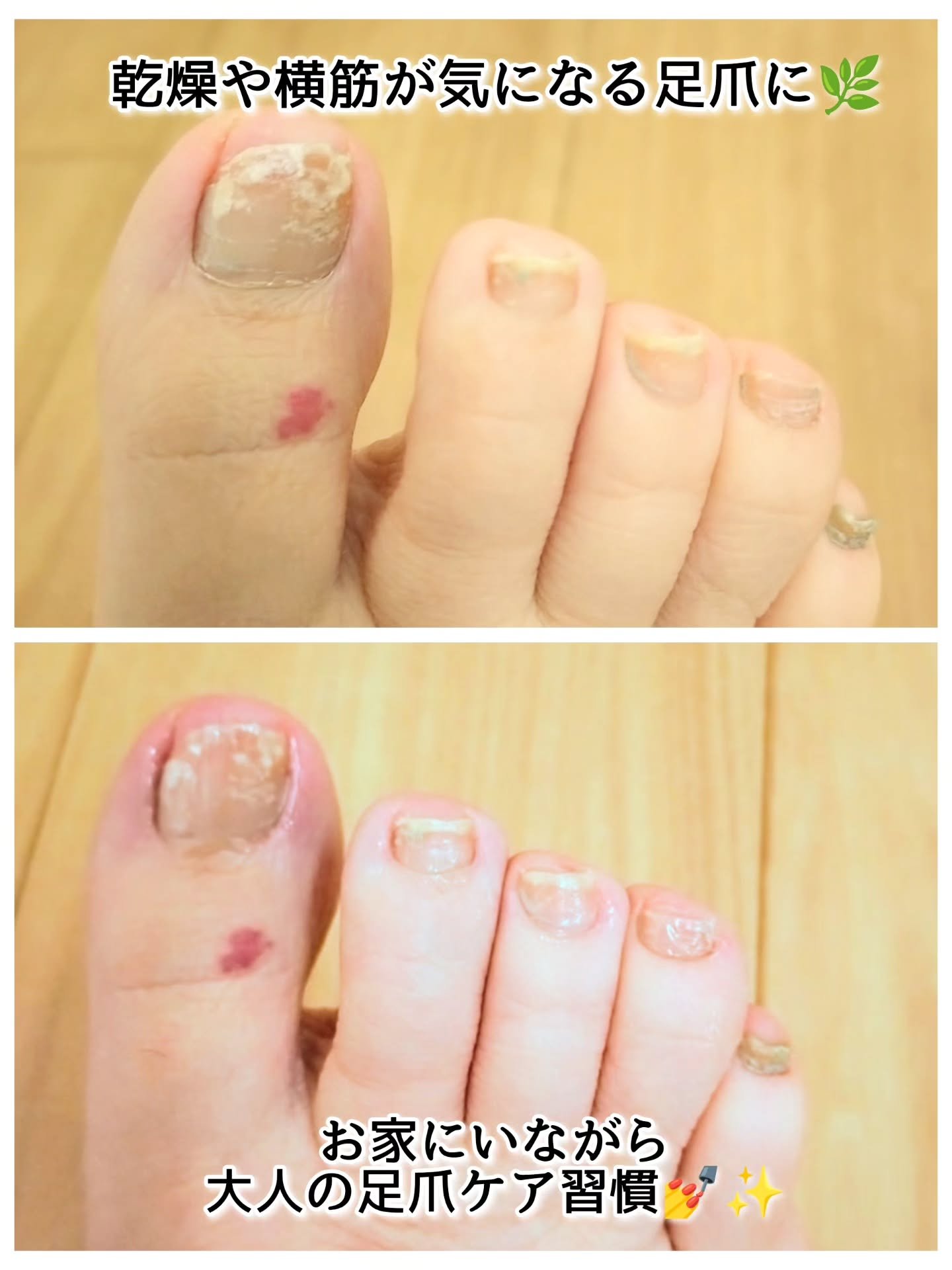 ベビーフット 足爪プロティンパック/ベビーフット/レッグ・フットケアを使ったクチコミ（3枚目）