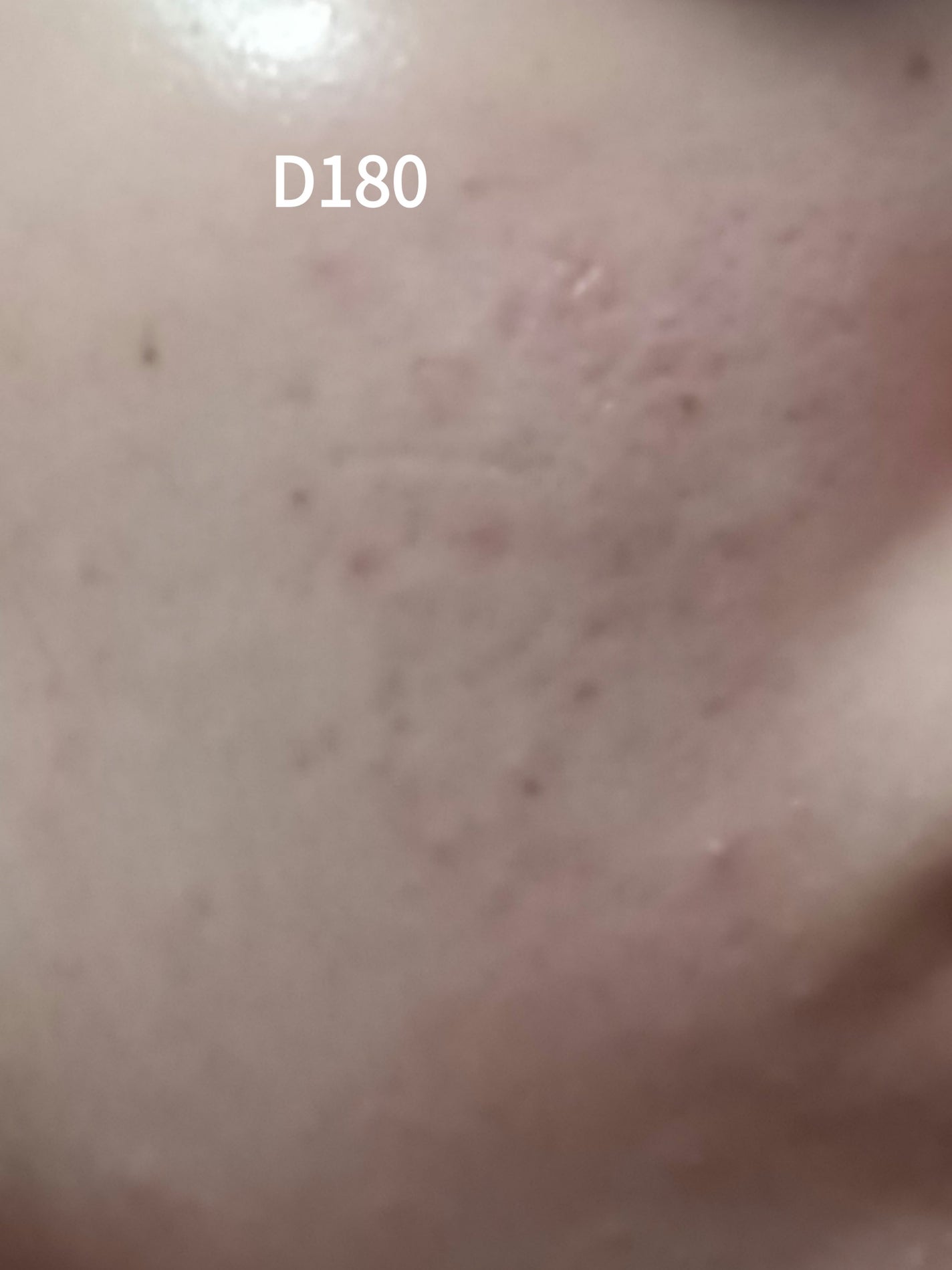 いぬ✢フォロバ100✢ on LIPS 「ニキビ記録180日目赤みが落ち着いて来たけど白ニキビポツポツで..」(1枚目)