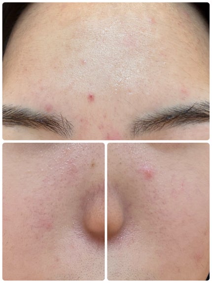 ディズム EMS EER メディスキンケアデバイス/DISM/美顔器・マッサージを使ったクチコミ(3枚目)