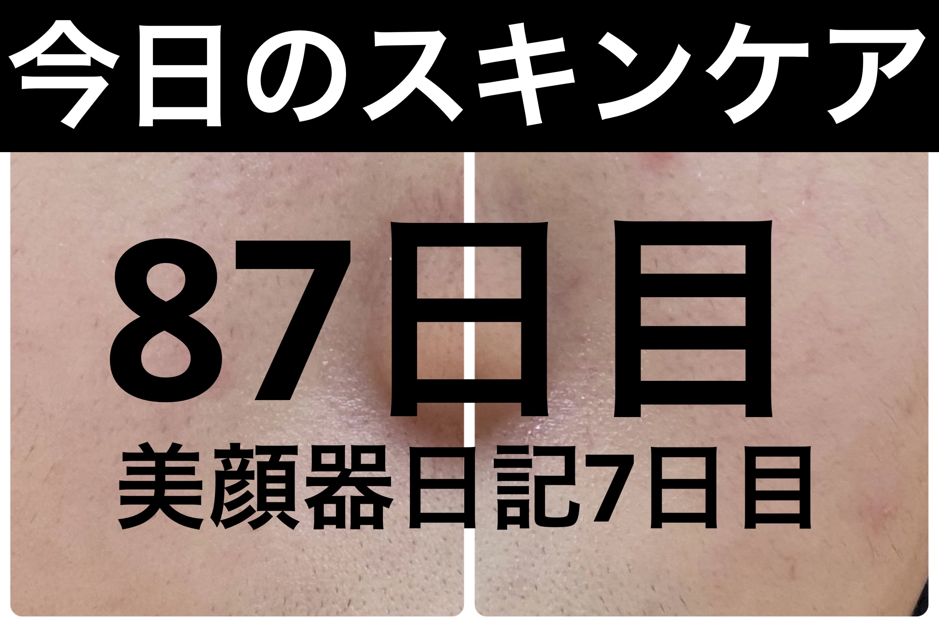 ディズム EMS EER メディスキンケアデバイス/DISM/美顔器・マッサージを使ったクチコミ（1枚目）