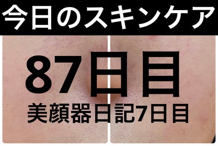 ディズム EMS EER メディスキンケアデバイス/DISM/美顔器・マッサージを使ったクチコミ(1枚目)