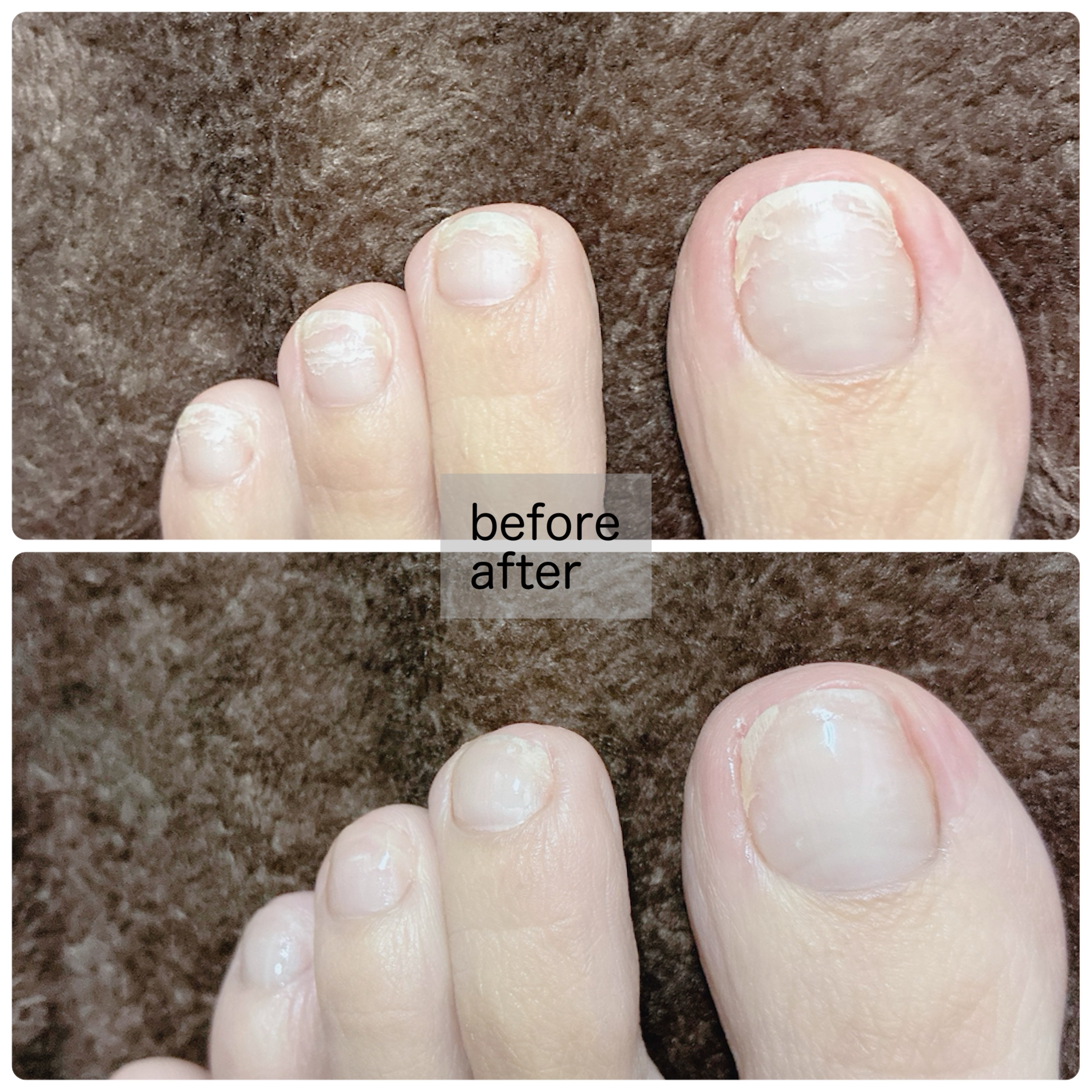 ベビーフット 足爪プロティンパック/ベビーフット/レッグ・フットケアを使ったクチコミ（3枚目）