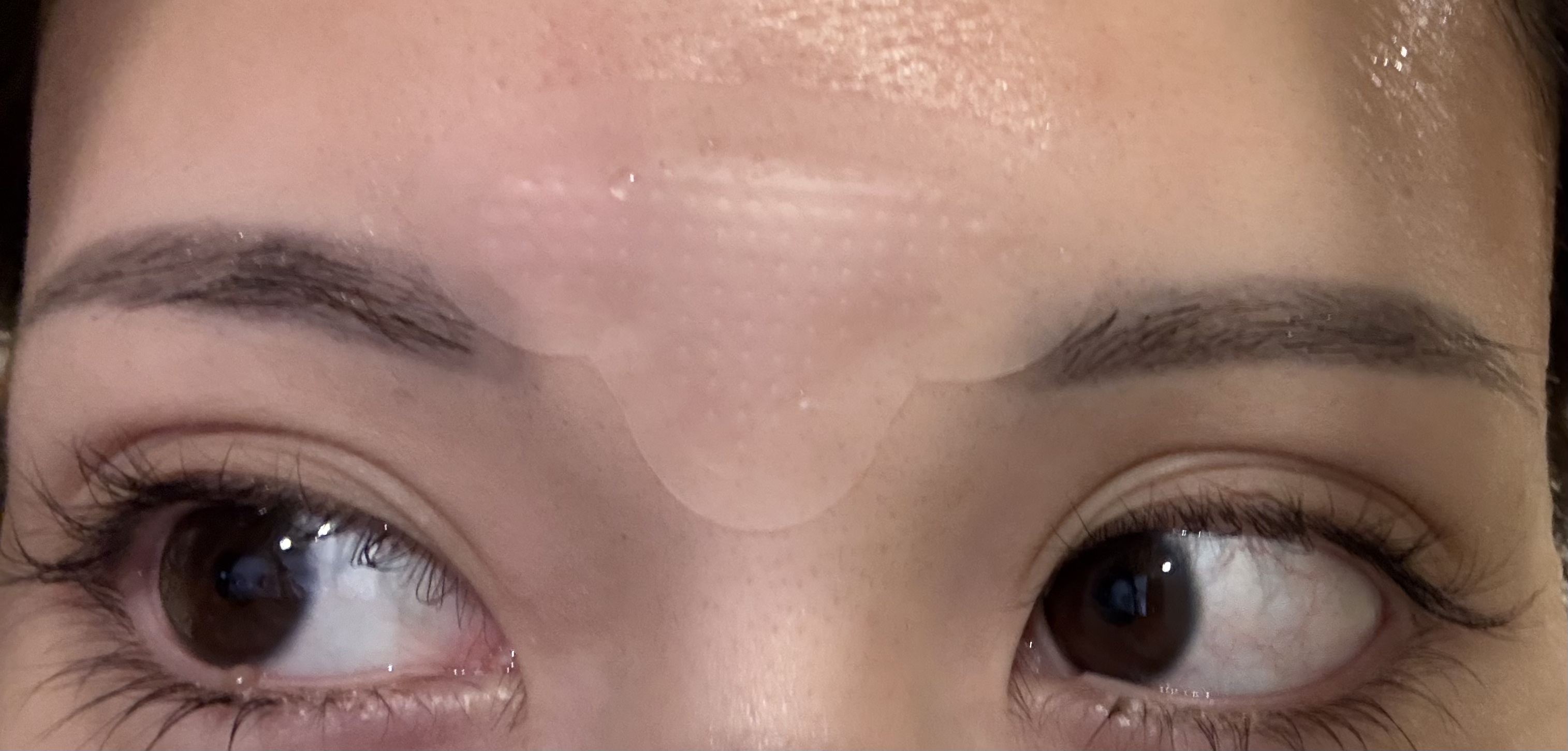 レチアールエヌ Tパッチ 4パウチ入り（1パウチ1パッチ入り）/ACROPASS/シートマスク・パックを使ったクチコミ（3枚目）