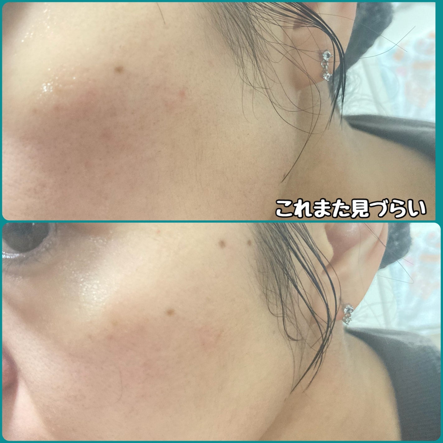 アゼライン酸15 インテンスカーミングセラム/Anua/美容液を使ったクチコミ(3枚目)