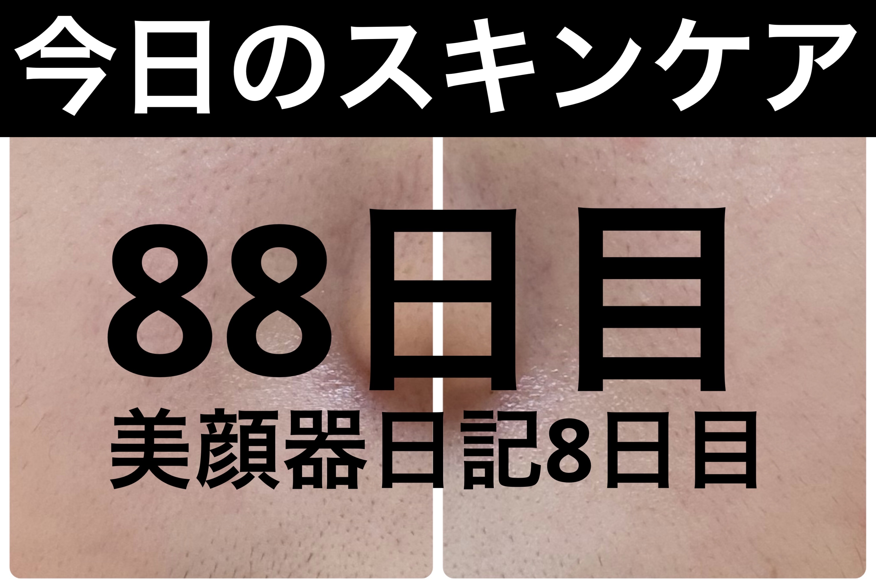 ディズム EMS EER メディスキンケアデバイス/DISM/美顔器・マッサージを使ったクチコミ（1枚目）