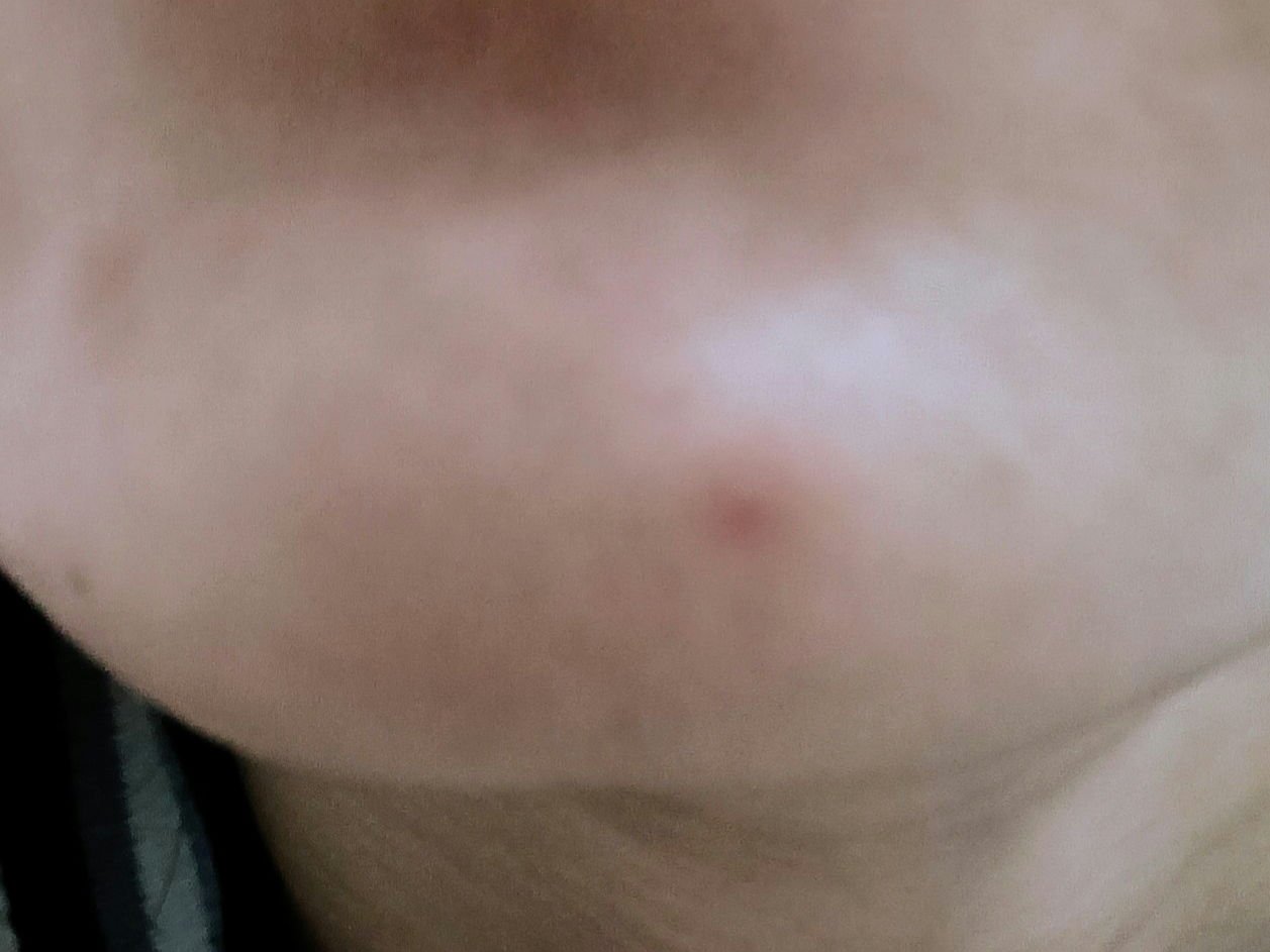 アットノン コンシーラータイプ(医薬品)/アットノン/その他を使ったクチコミ（2枚目）