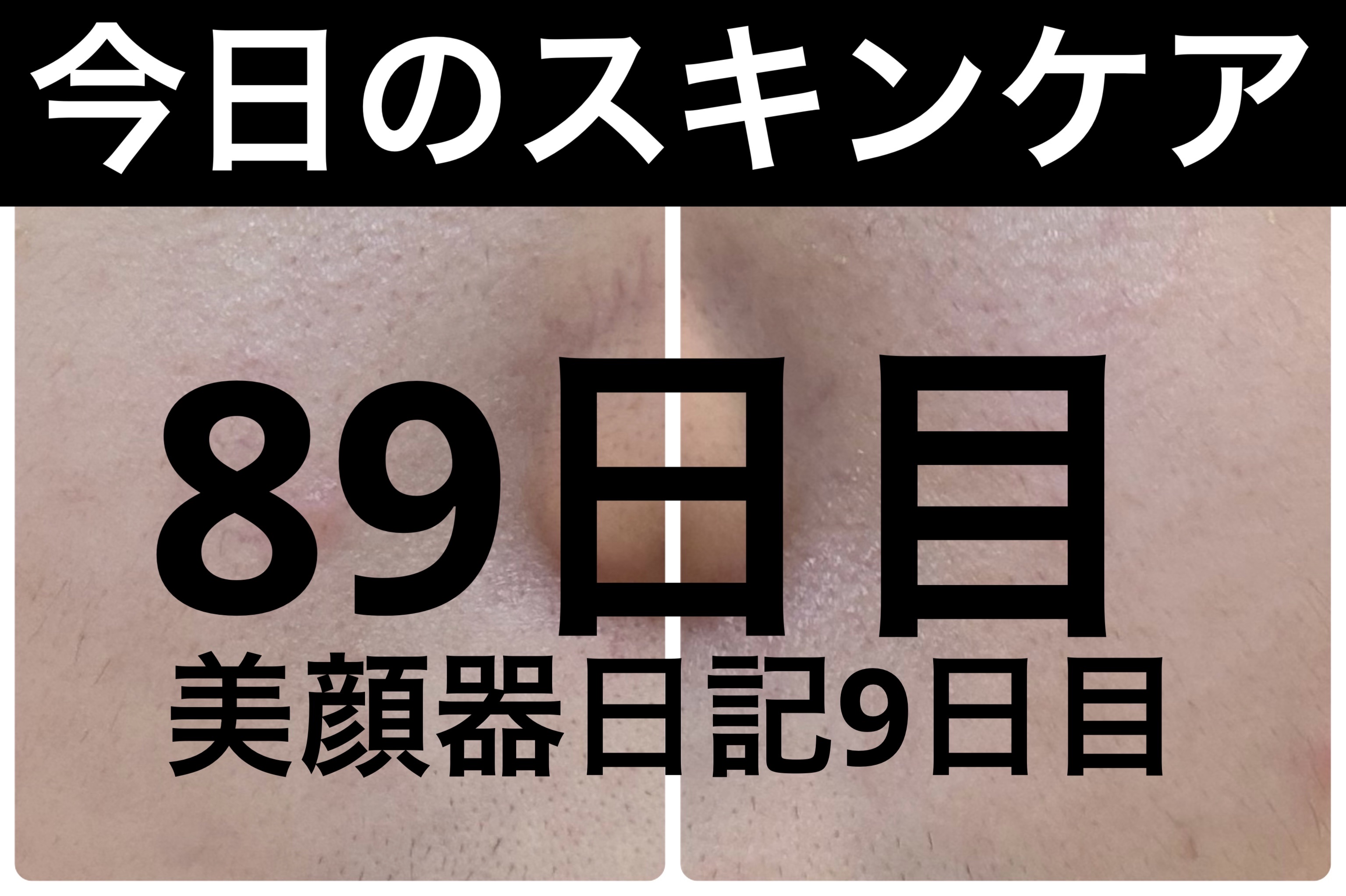 ディズム EMS EER メディスキンケアデバイス/DISM/美顔器・マッサージを使ったクチコミ（1枚目）