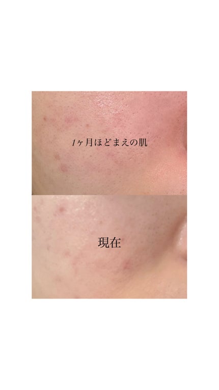 バイオイル/バイオイル/フェイスオイルを使ったクチコミ(2枚目)