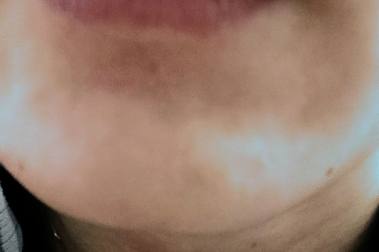 アットノン コンシーラータイプ(医薬品)/アットノン/その他を使ったクチコミ（3枚目）