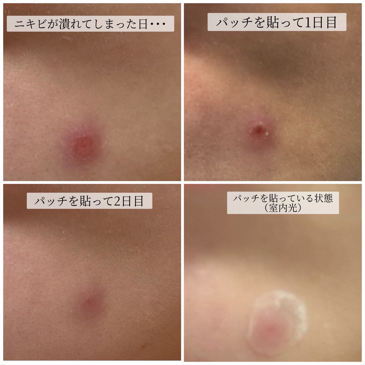 プロCICA クリアスポットパッチ/VT/その他スキンケアを使ったクチコミ(3枚目)