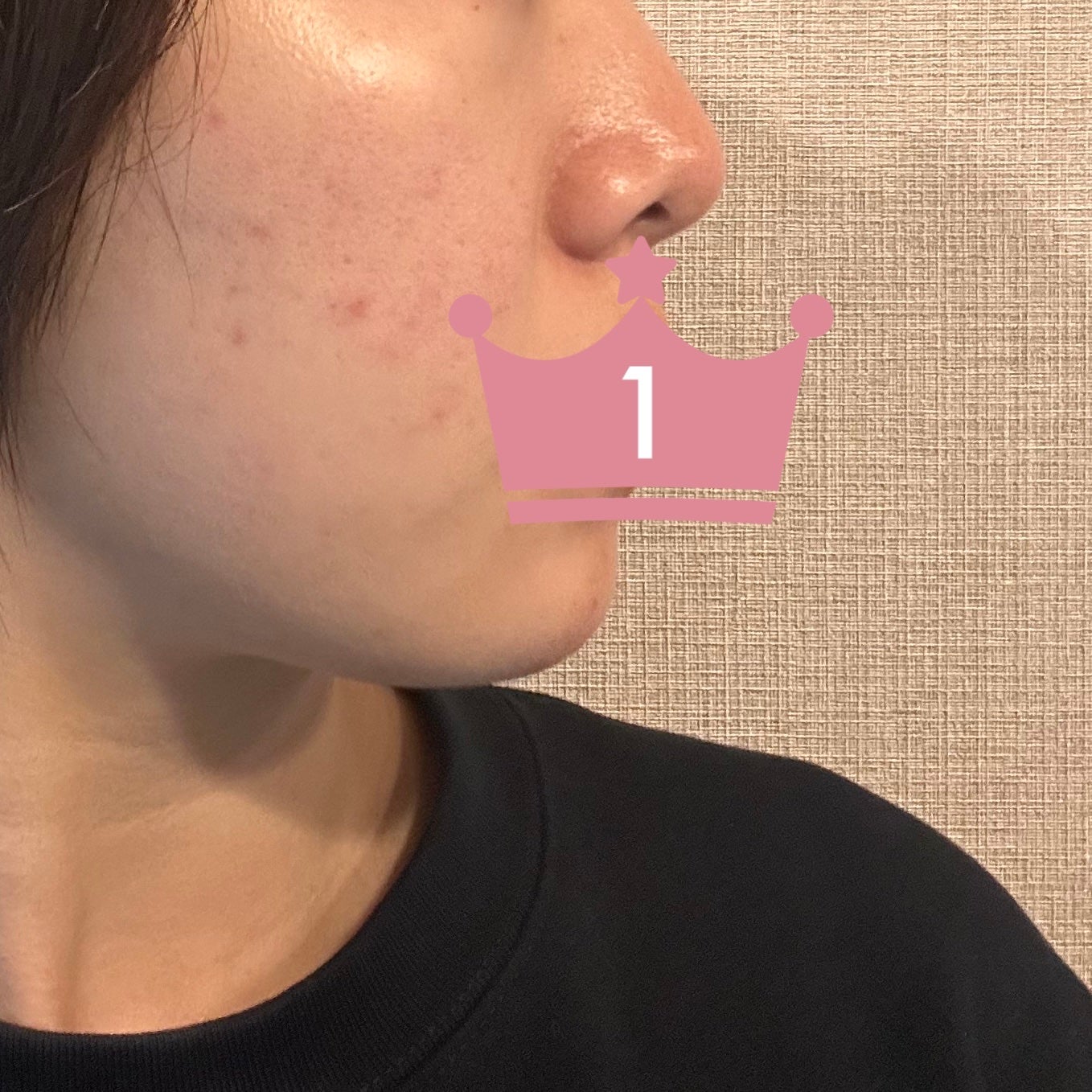 たべっこ on LIPS 「12/20ちょっとプツプツニキビできてしまう..」(3枚目)