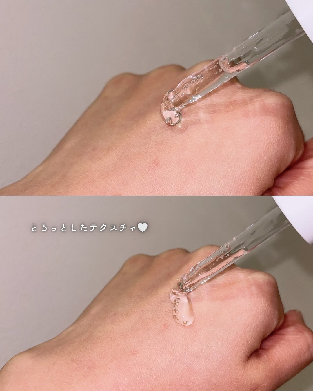 アネトス アクネケア トリートメント セラム/Anetos/美容液を使ったクチコミ（3枚目）