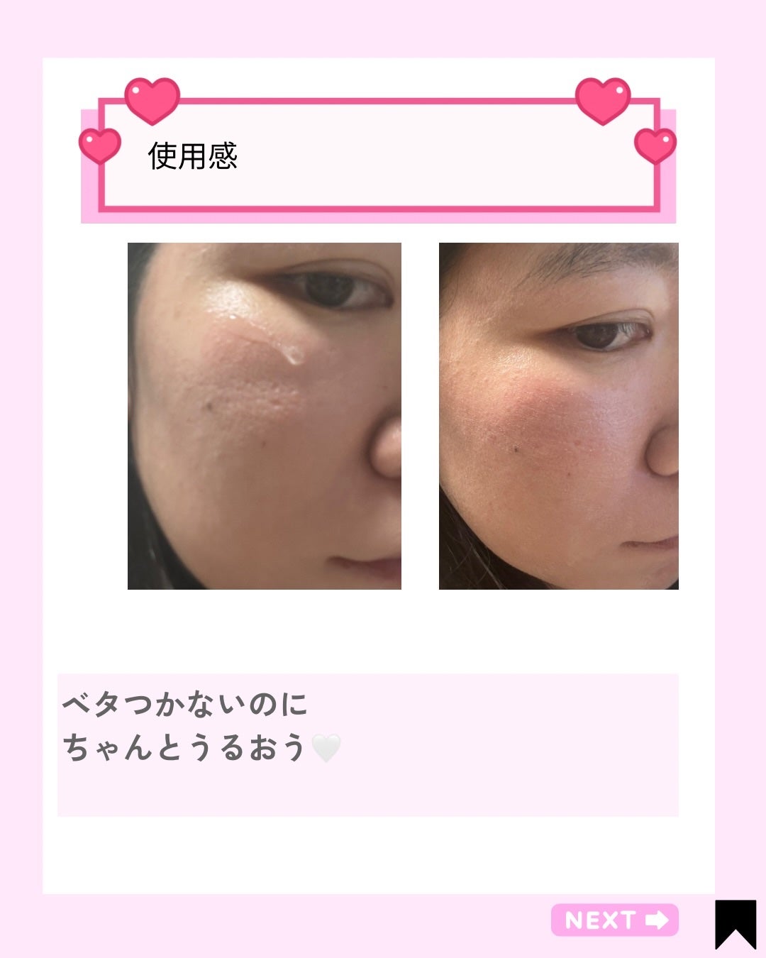 アネトス アクネケア トリートメント セラム/Anetos/美容液を使ったクチコミ(5枚目)