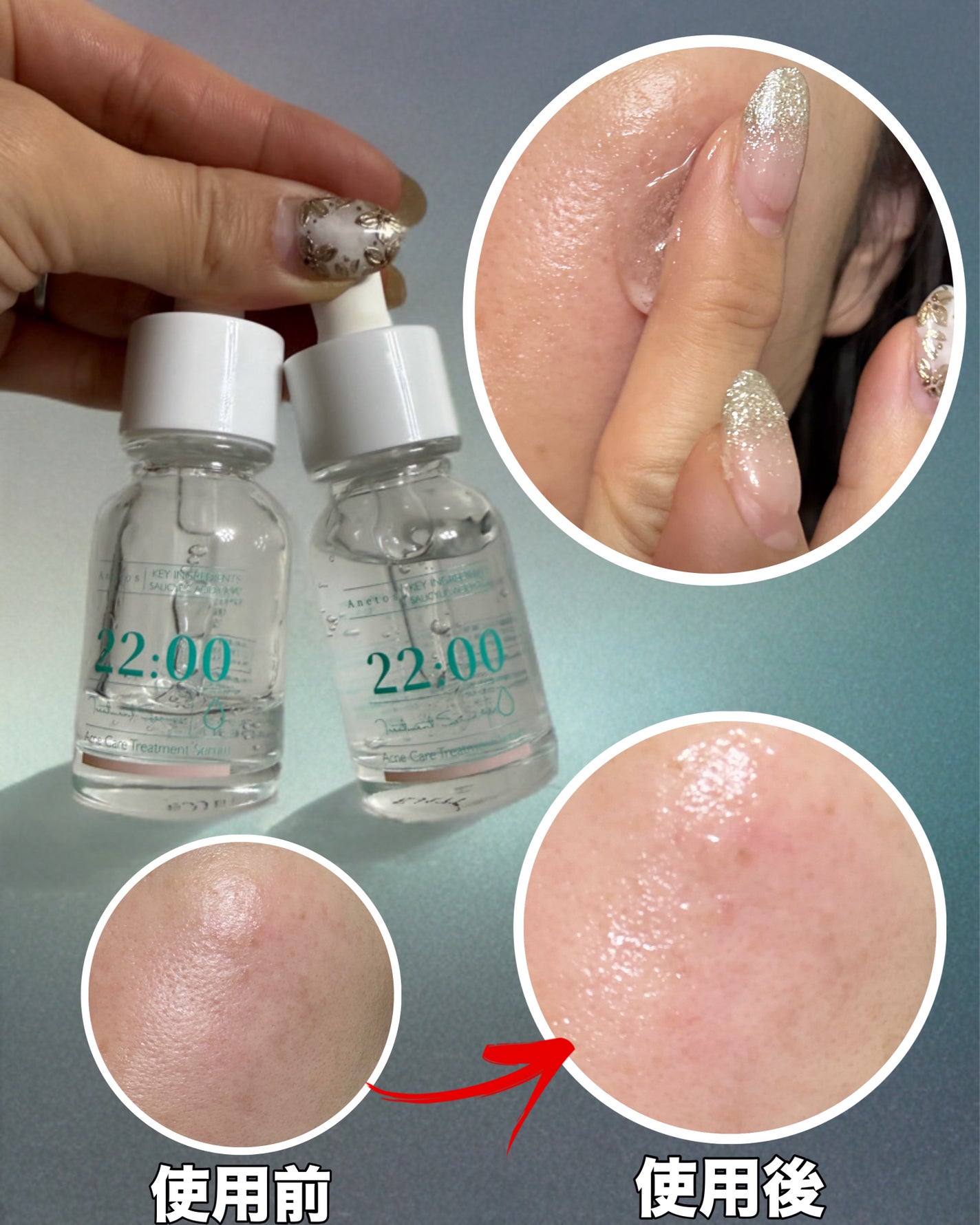 アネトス アクネケア トリートメント セラム/Anetos/美容液を使ったクチコミ(5枚目)