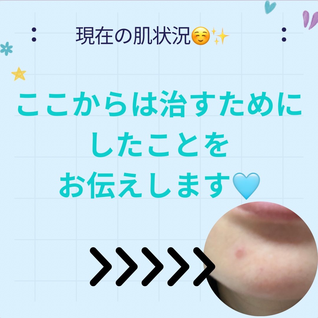 ペアアクネクリームW(医薬品)/ペア/その他を使ったクチコミ（3枚目）