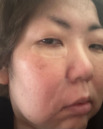 レチアールエヌ スリムパッチ/ACROPASS/シートマスク・パックを使ったクチコミ(3枚目)