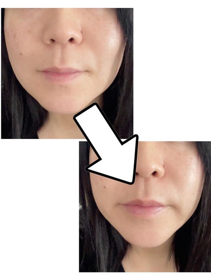 ボリュームプラス リップエッセンスUV/アンテリージェEX/リップ美容液を使ったクチコミ(5枚目)