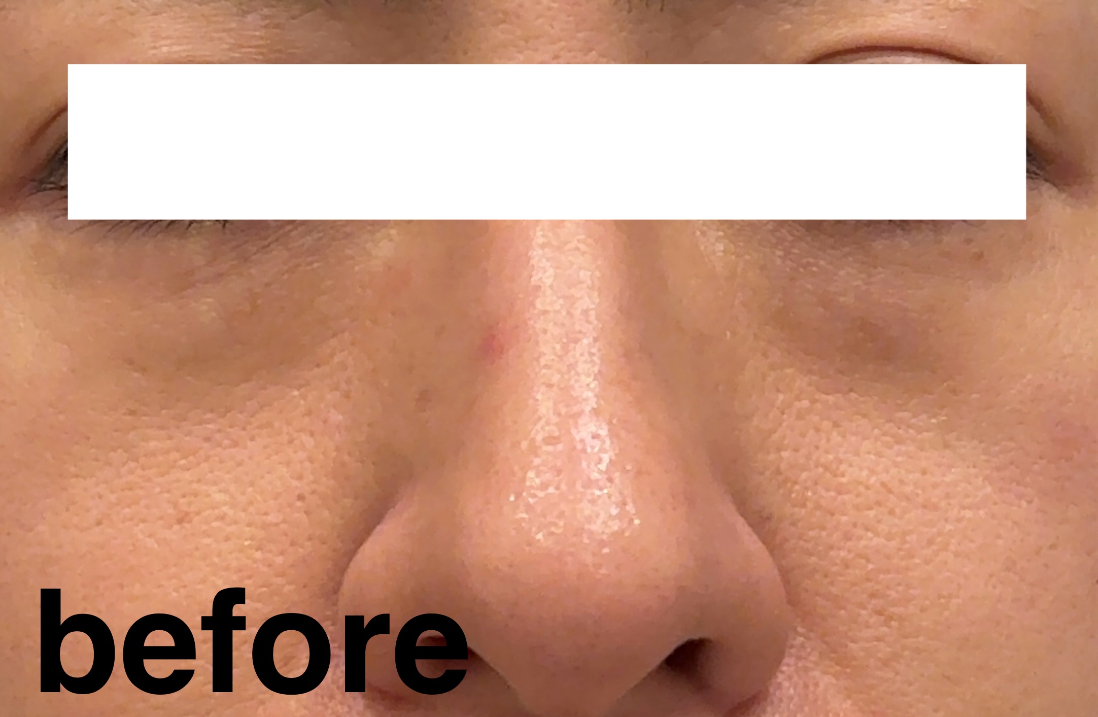 Balance Flow アークパントンヒール のクチコミ「ニキビができやすくて悩んでいたのでトラブルケアサプリを初購入しました。
鼻にニキビができたので.....」（1枚目）