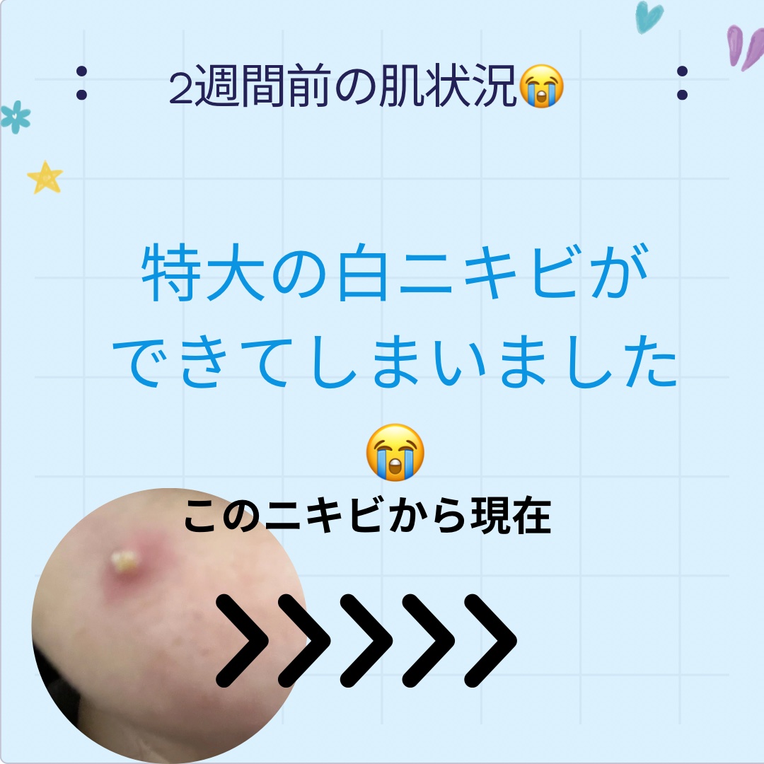 ペアアクネクリームW(医薬品)/ペア/その他を使ったクチコミ（2枚目）