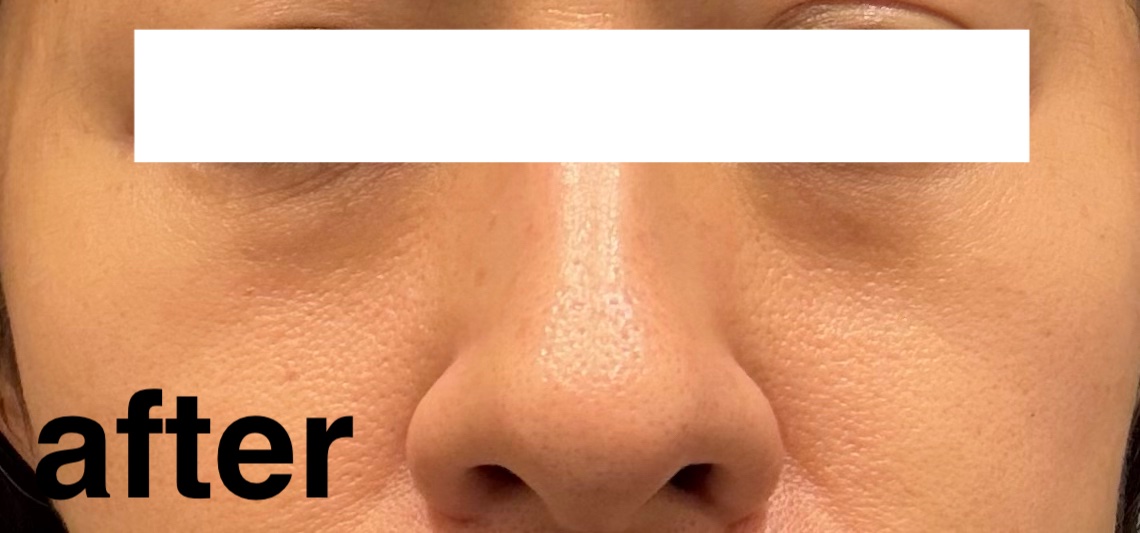 Balance Flow アークパントンヒール のクチコミ「ニキビができやすくて悩んでいたのでトラブルケアサプリを初購入しました。
鼻にニキビができたので.....」（2枚目）