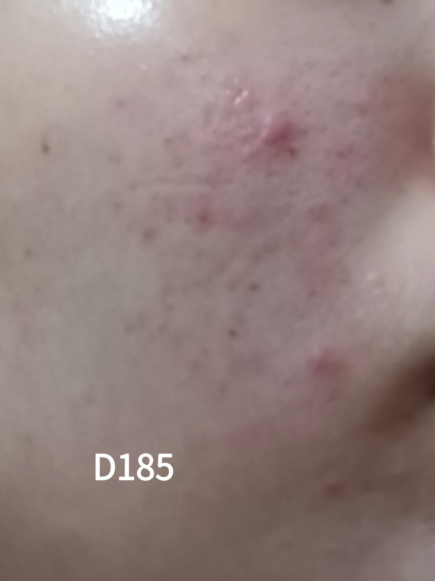 いぬ✢フォロバ100✢ on LIPS 「ニキビ記録185日目赤みは良くなってるけどニキビが悪化してる今..」(1枚目)