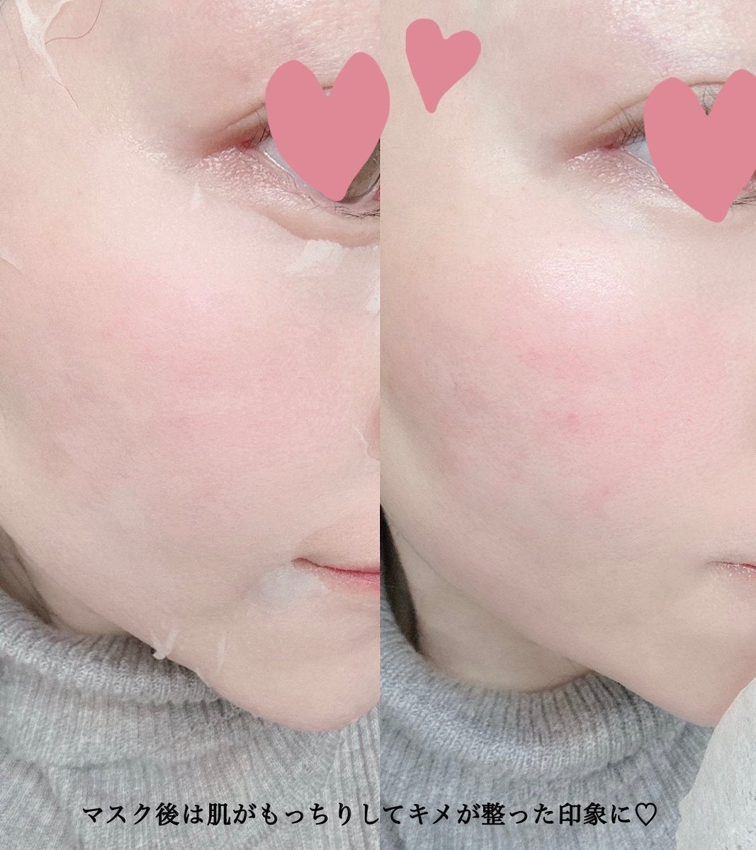 PDRN リフティングマスク/MEDIHEAL/シートマスク・パックを使ったクチコミ(4枚目)