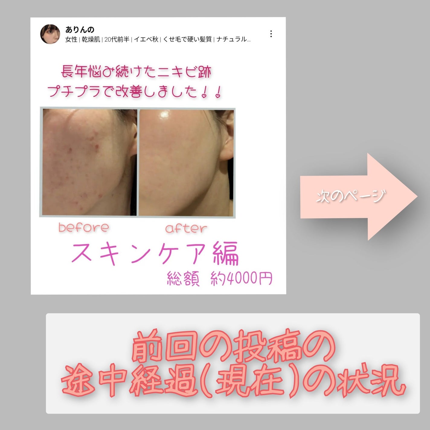 バイオイル/バイオイル/フェイスオイルを使ったクチコミ(1枚目)