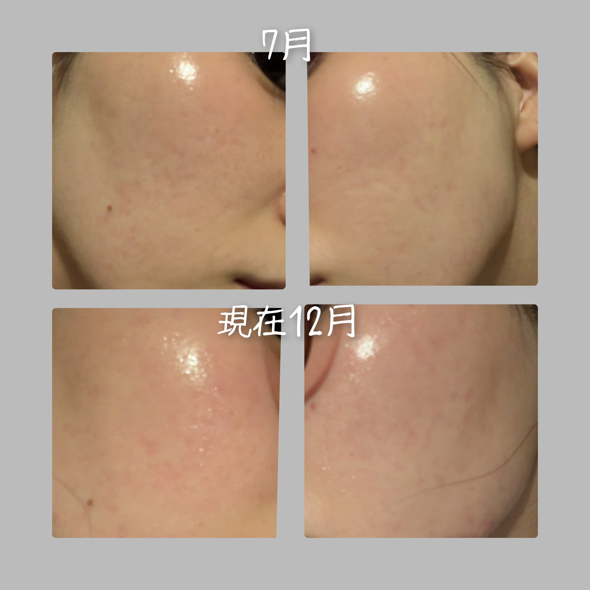 バイオイル 60mL/バイオイル/フェイスオイルを使ったクチコミ（2枚目）