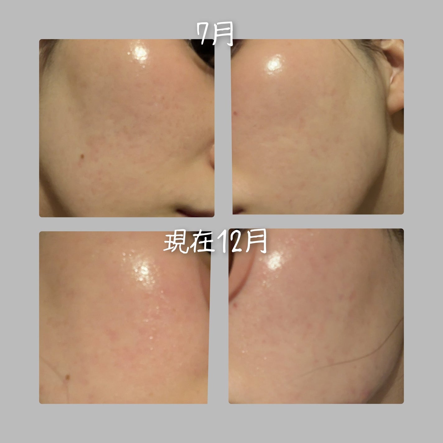 バイオイル/バイオイル/フェイスオイルを使ったクチコミ(2枚目)