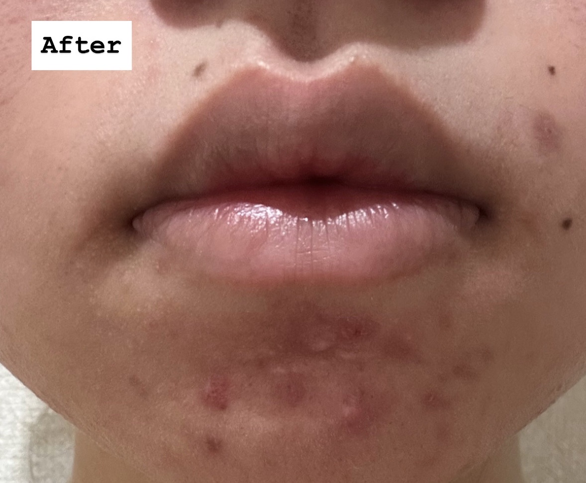 薬用クリアケアスポットエッセンス/無印良品/美容液を使ったクチコミ（3枚目）