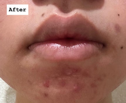 薬用クリアケアスポットエッセンス/無印良品/美容液を使ったクチコミ(3枚目)