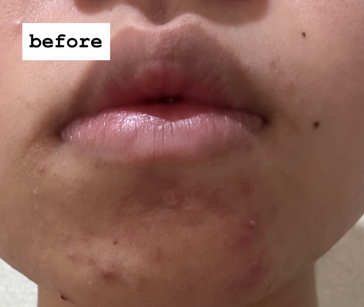 薬用クリアケアスポットエッセンス/無印良品/美容液を使ったクチコミ（2枚目）