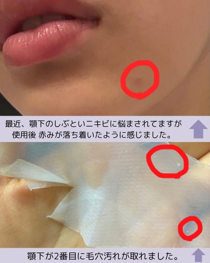 トラブルパッチマスク/EIOM/その他スキンケアを使ったクチコミ(5枚目)