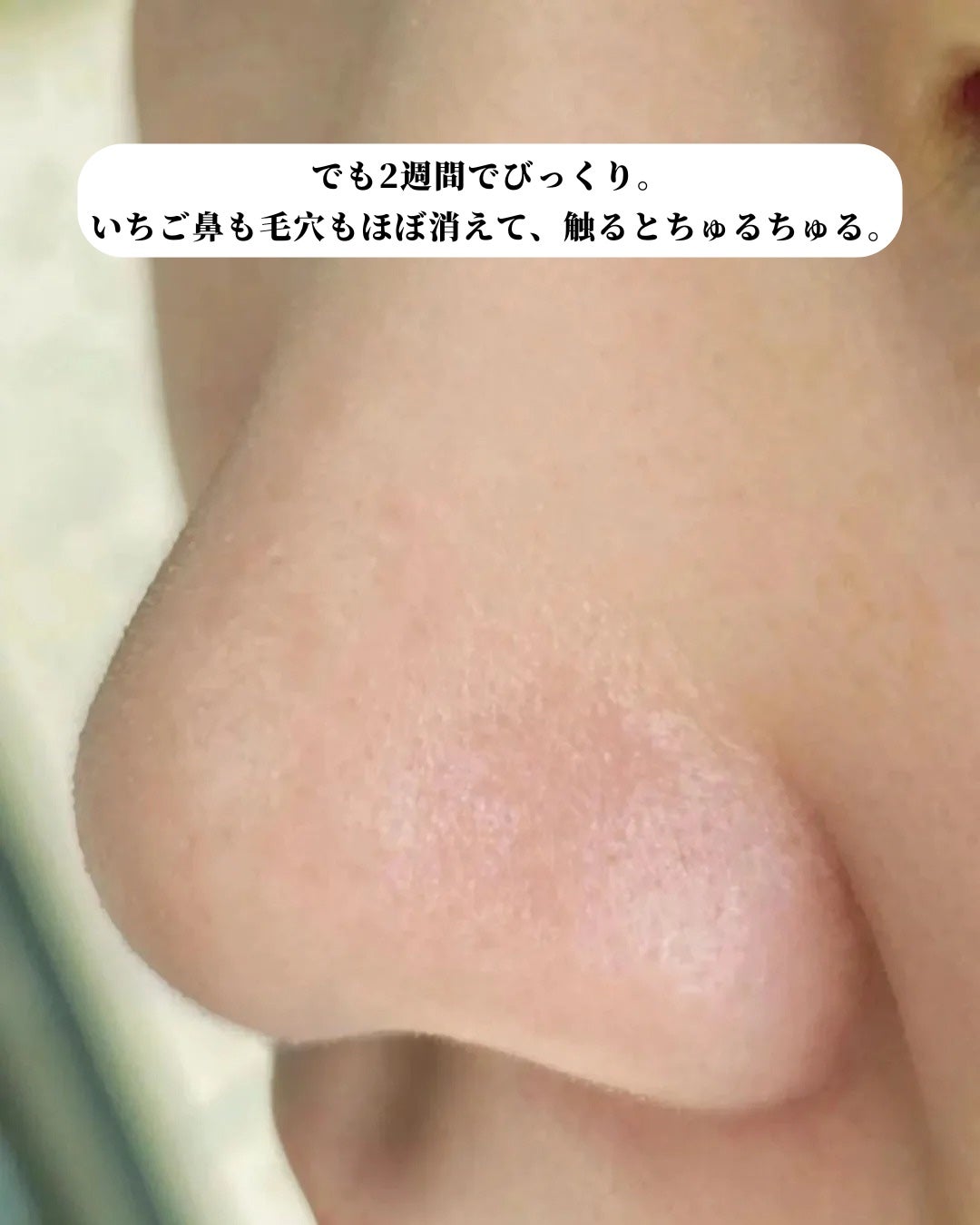 アネトス アクネケア トリートメント セラム/Anetos/美容液を使ったクチコミ(4枚目)