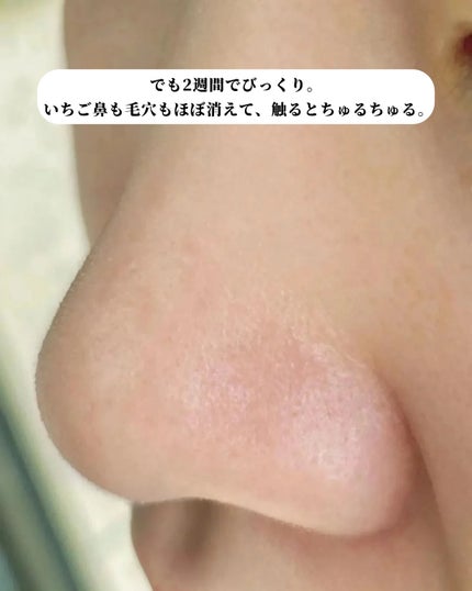 アネトス アクネケア トリートメント セラム/Anetos/美容液を使ったクチコミ(4枚目)