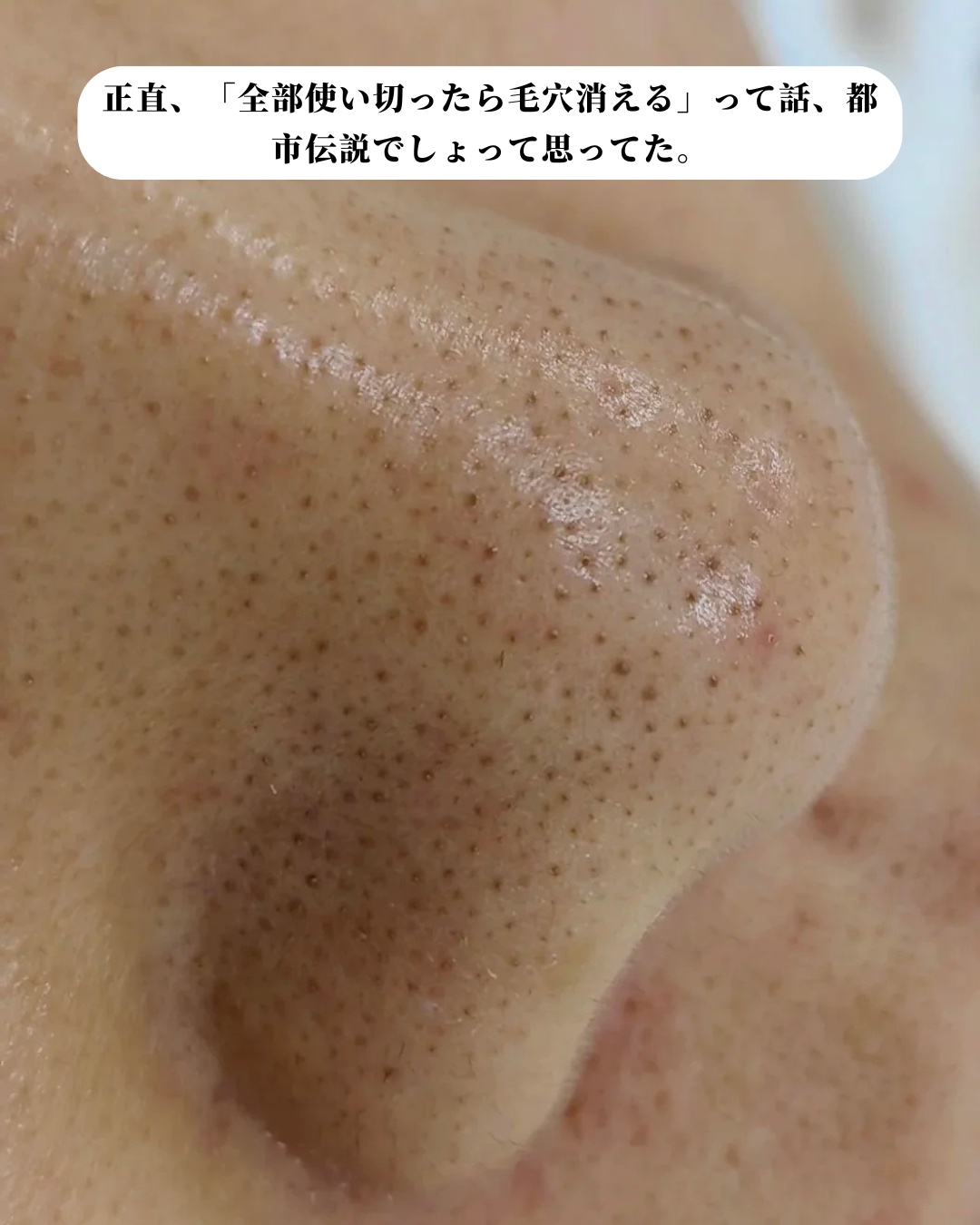 アネトス アクネケア トリートメント セラム/Anetos/美容液を使ったクチコミ（3枚目）