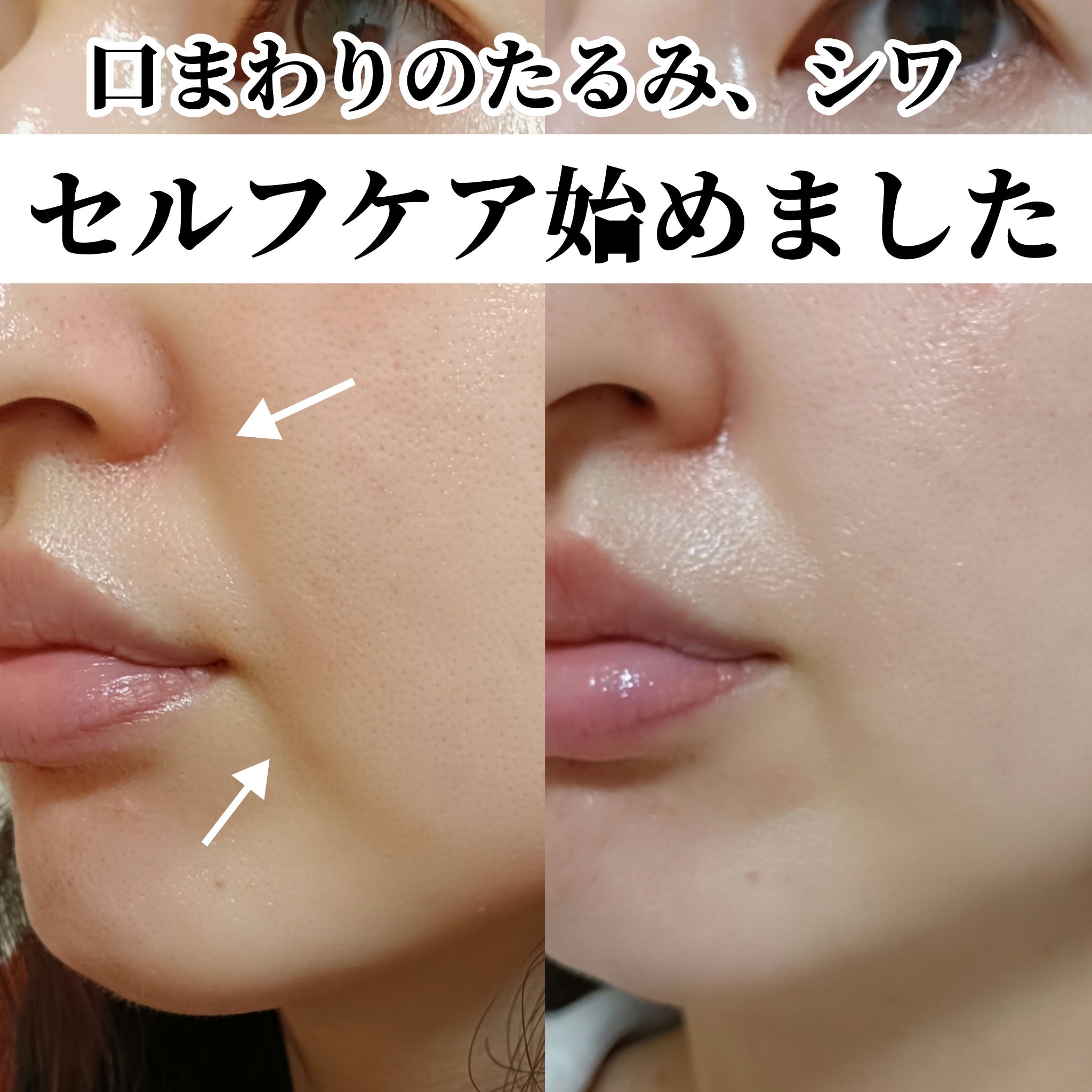 【口まわりのたるみシワケアまとめ】

クマと口周りのたるみシワが気になってセルフケア(マッサージ？体操？)を始めて3週間ほど。

とりあえず顔をベタベタ触ったり、素人なので変に筋肉を押したりはしてません。
プロの方の動画を参考にズボラな私で