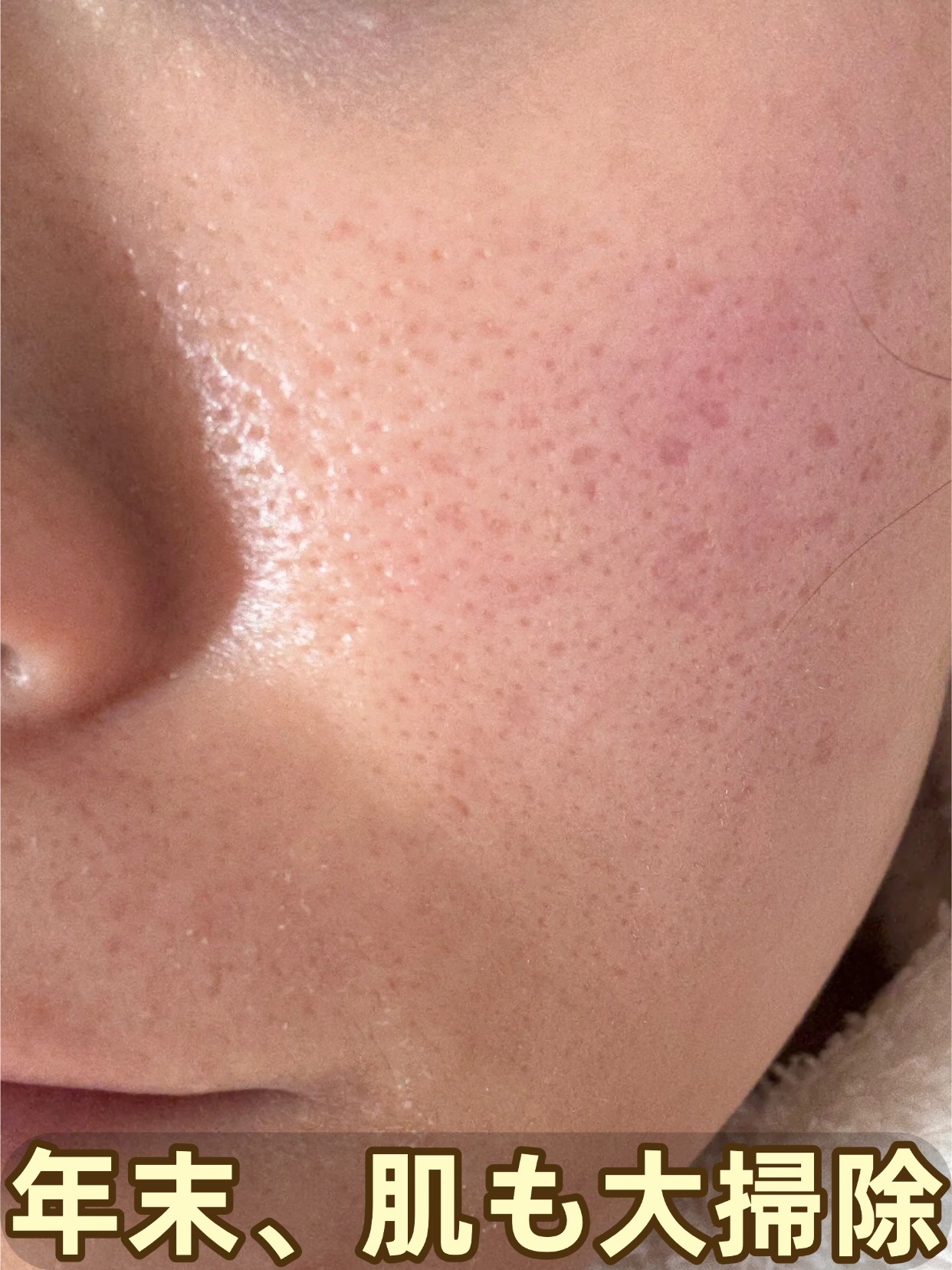 アネトス アクネケア トリートメント セラム/Anetos/美容液を使ったクチコミ（1枚目）