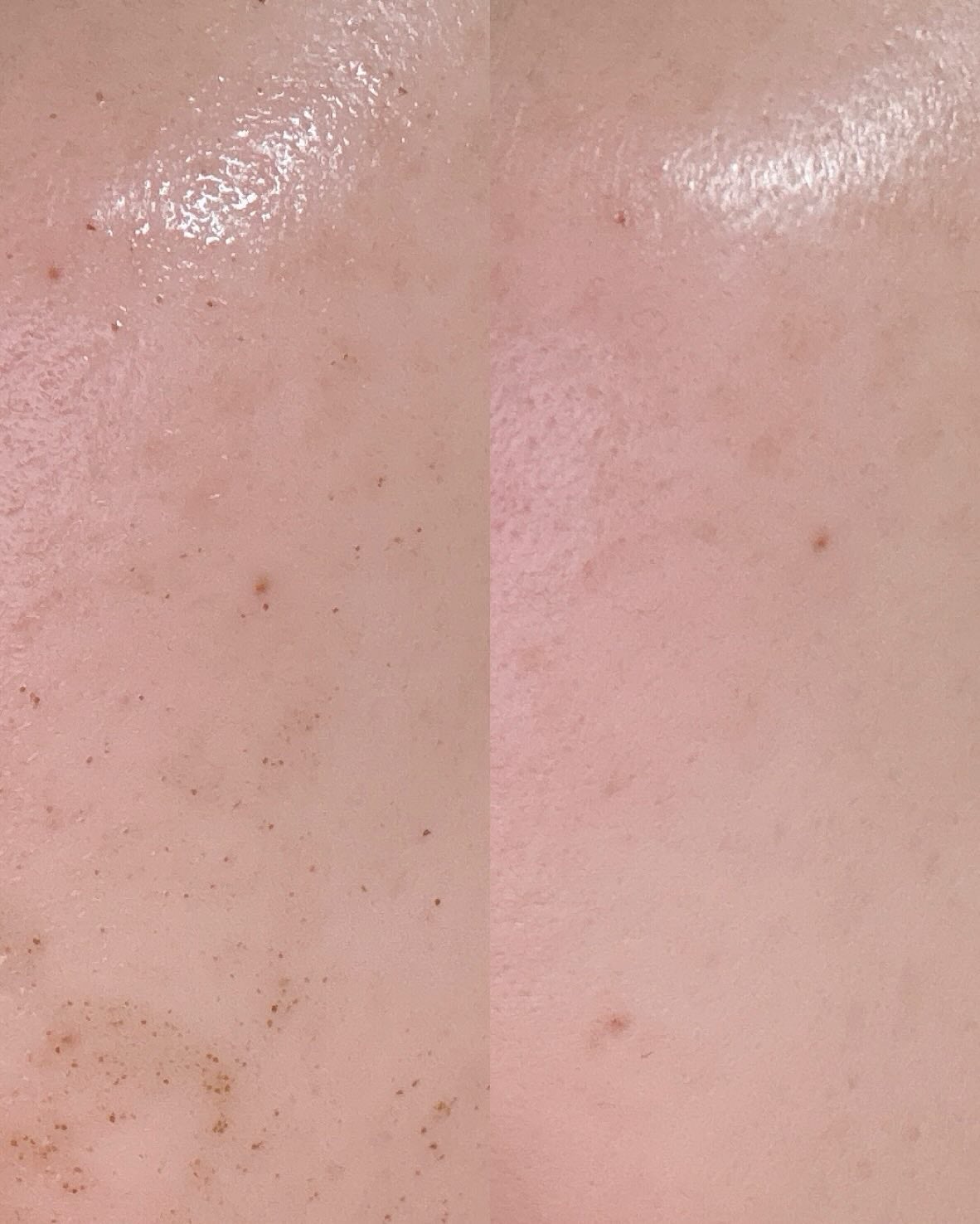 ハーブピーリング/on:myskin/ピーリングを使ったクチコミ(3枚目)