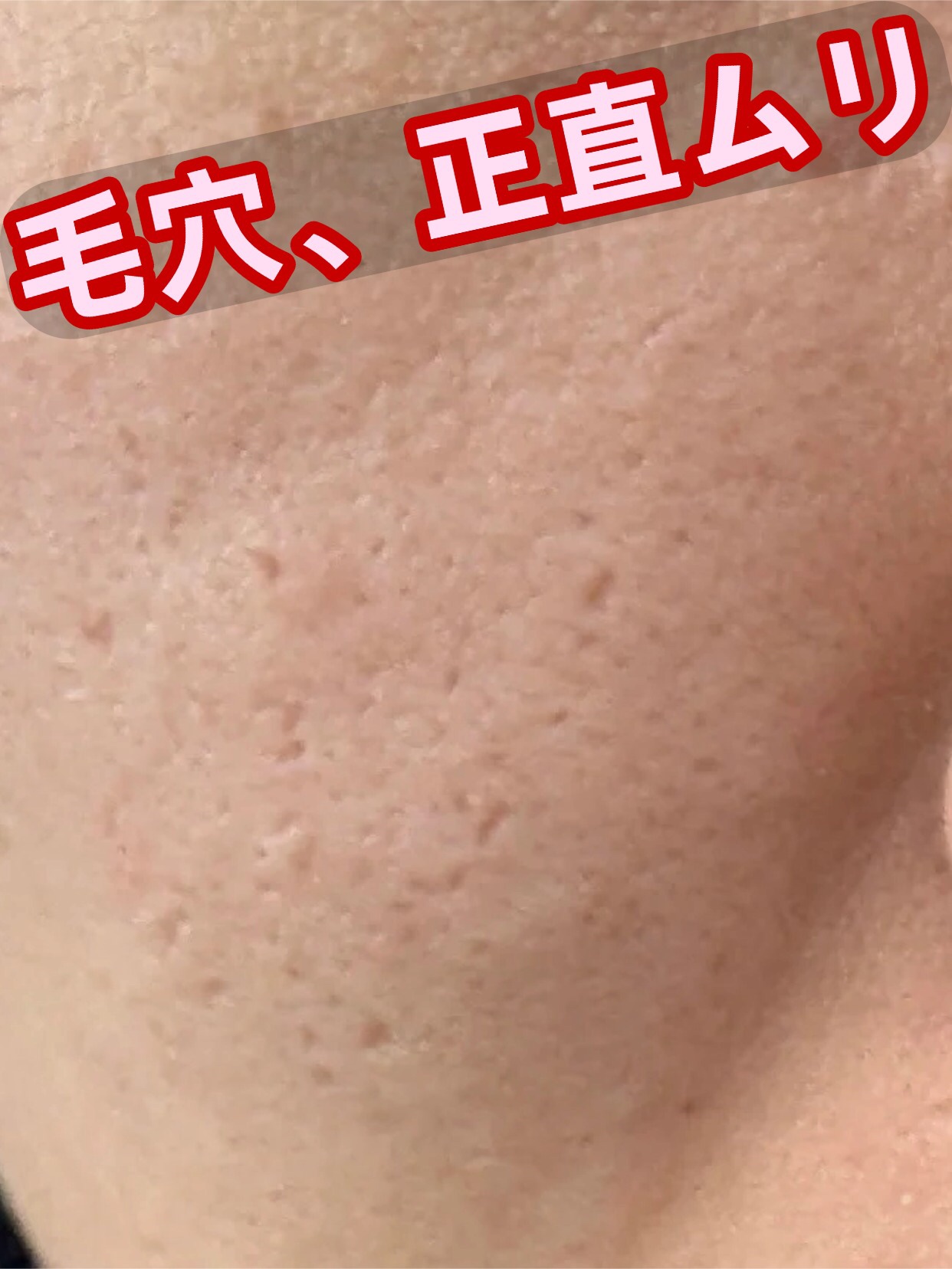 アネトス アクネケア トリートメント セラム/Anetos/美容液を使ったクチコミ（1枚目）