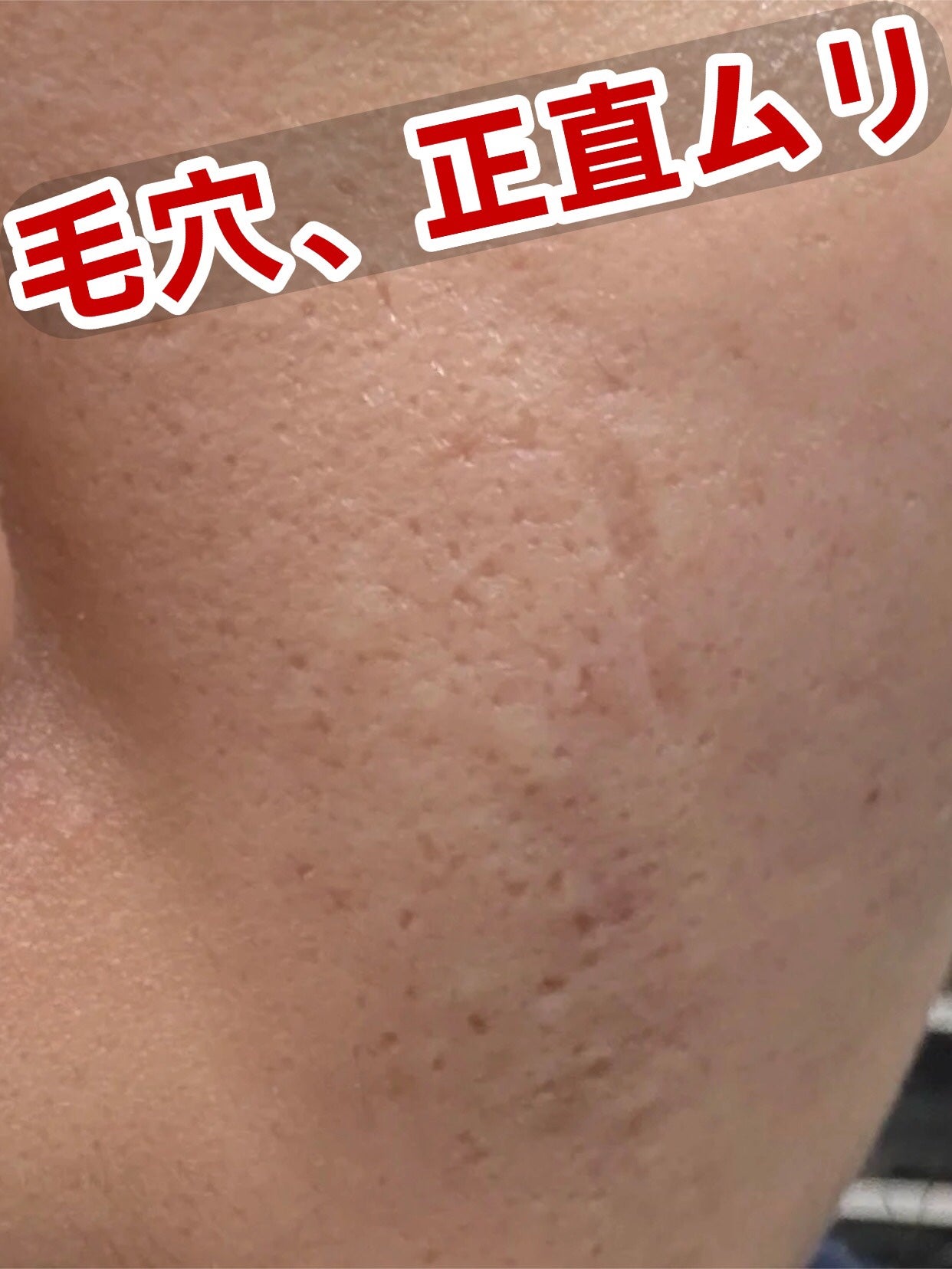 アネトス アクネケア トリートメント セラム/Anetos/美容液を使ったクチコミ(1枚目)