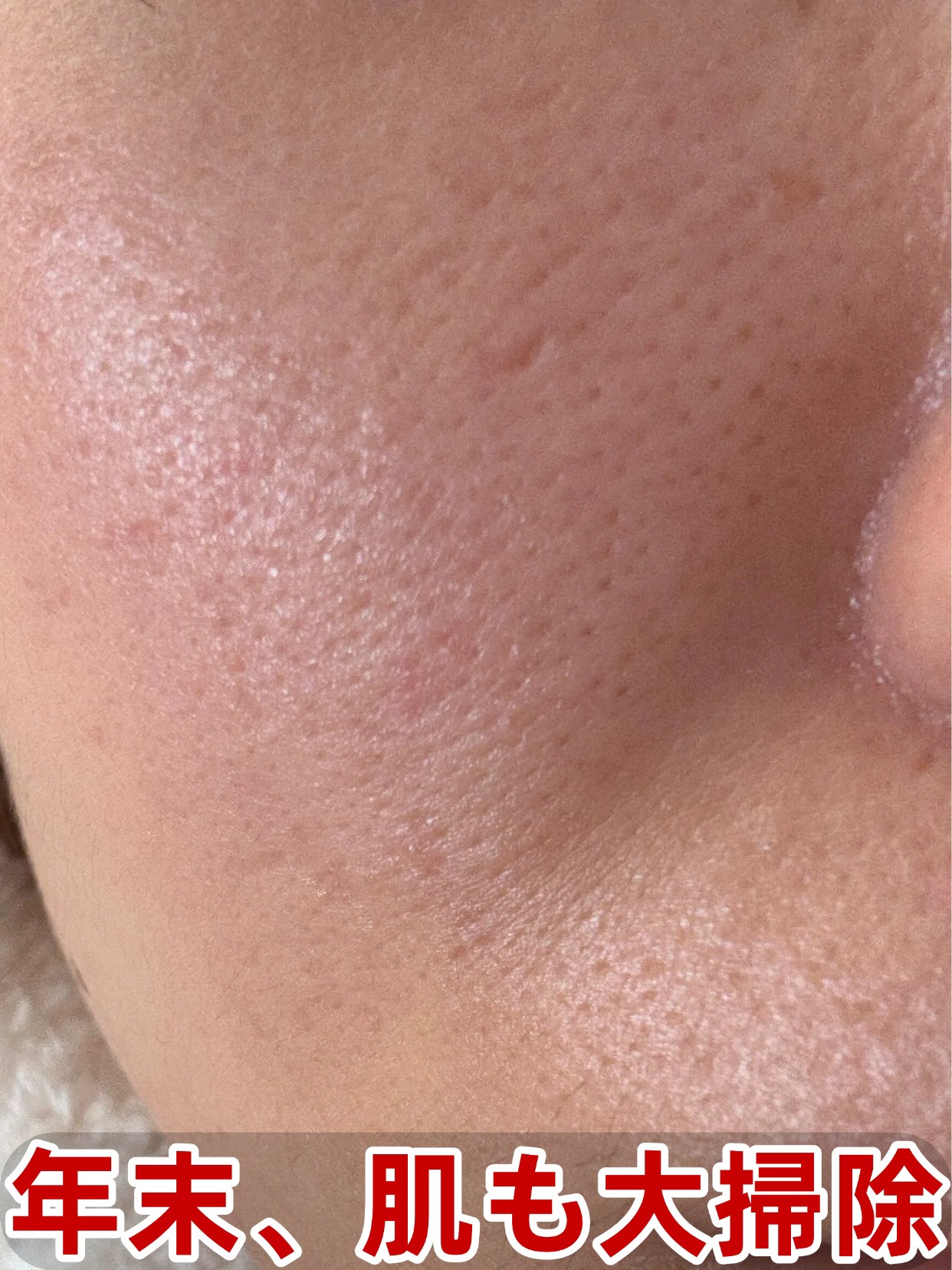 アネトス アクネケア トリートメント セラム/Anetos/美容液を使ったクチコミ（1枚目）