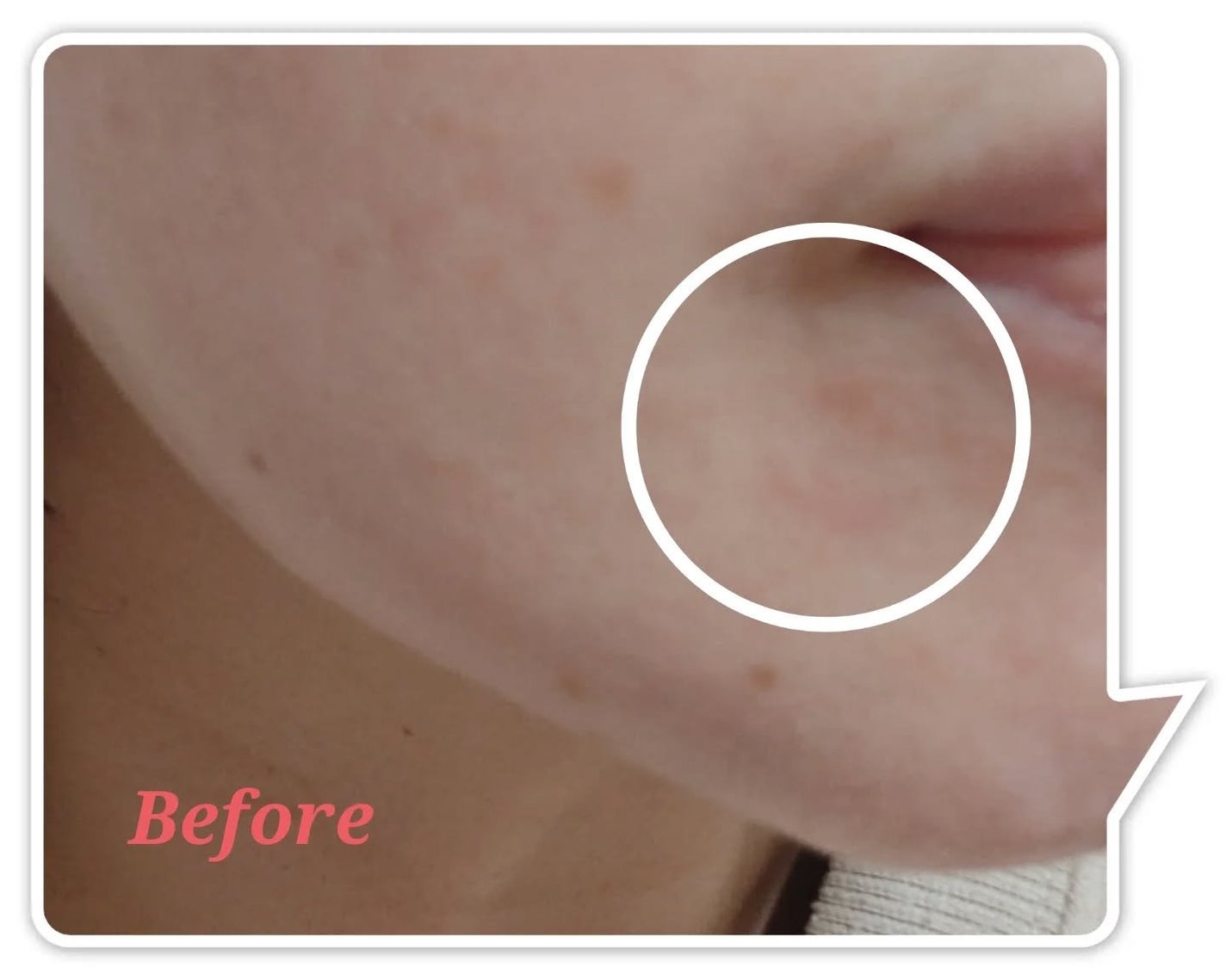 ACマグネシウムパッチ/スノーツープラス/シートマスク・パックを使ったクチコミ(8枚目)