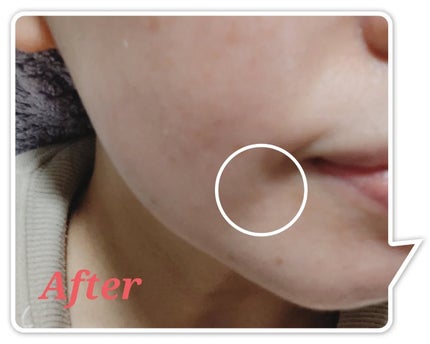 ACマグネシウムパッチ/スノーツープラス/シートマスク・パックを使ったクチコミ(9枚目)